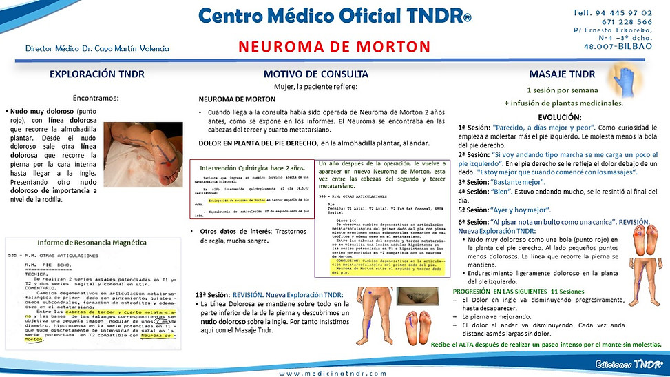 Neuroma de Morton.jpg