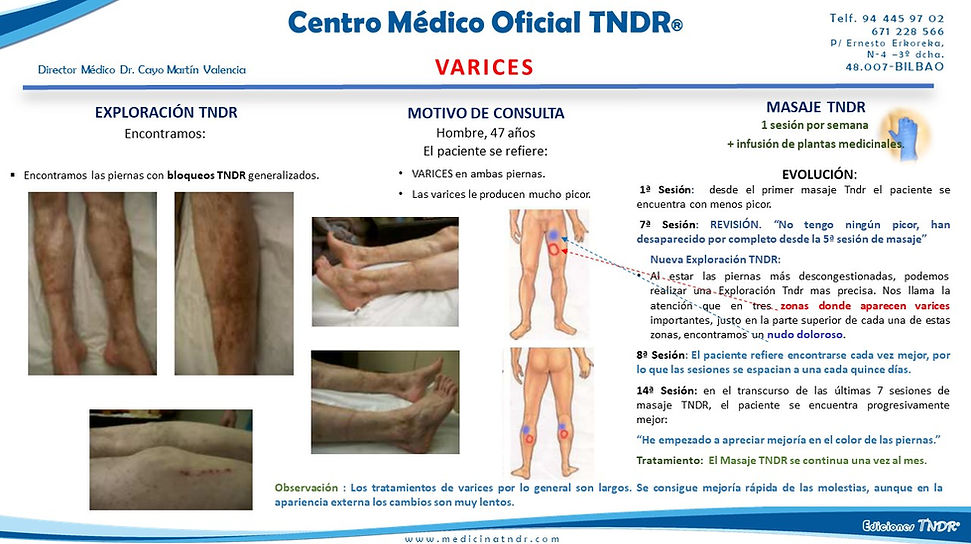 VARICES.jpg