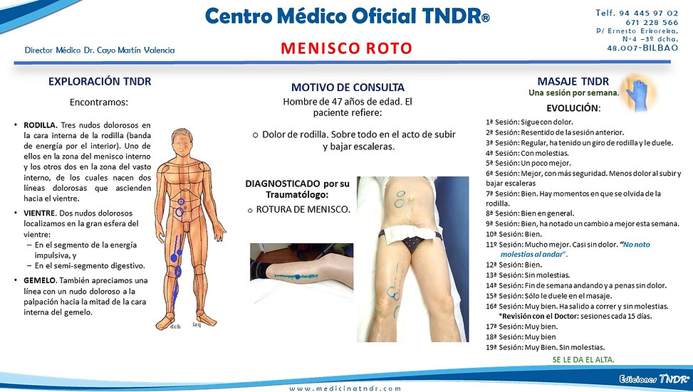 Caso Clínico de Artrosis de Rodill