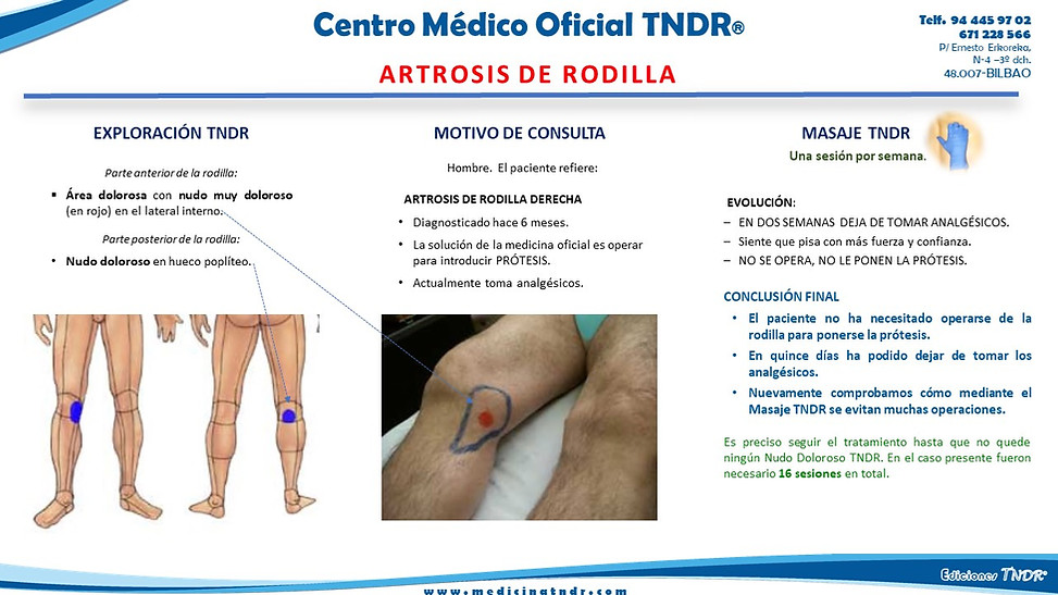 Artrosis de rodilla.jpg